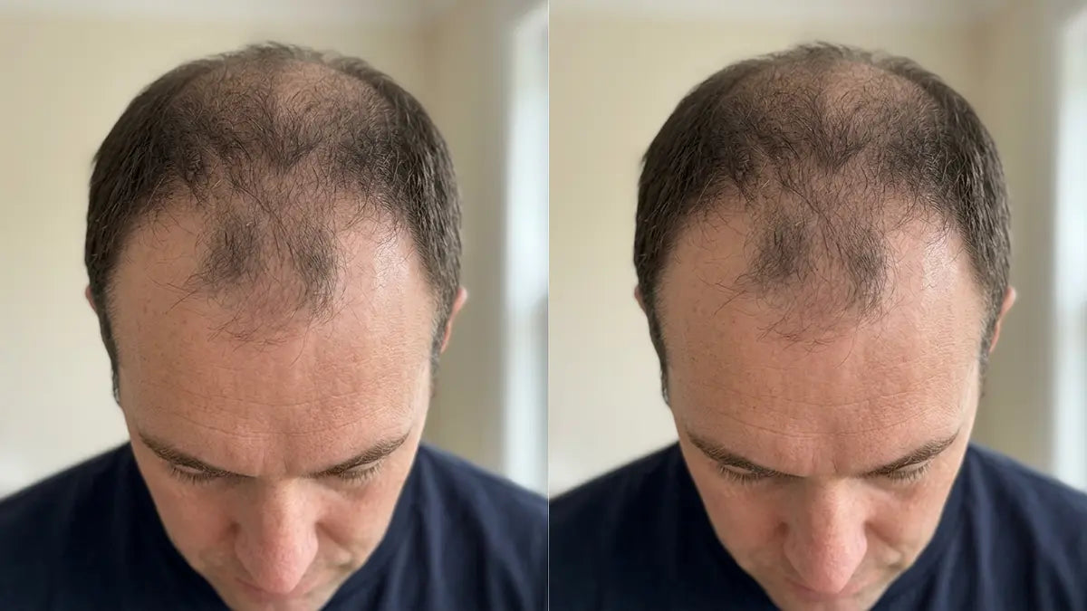 Customer before and after — crown regrowth