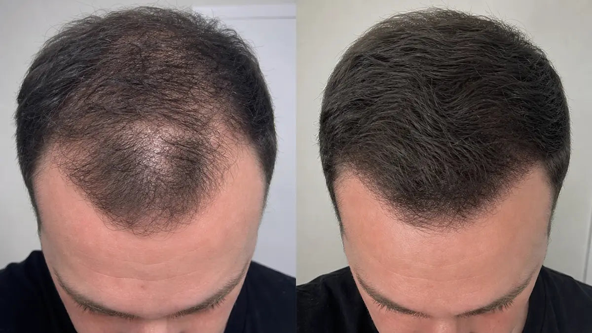 Customer before and after — top down crown