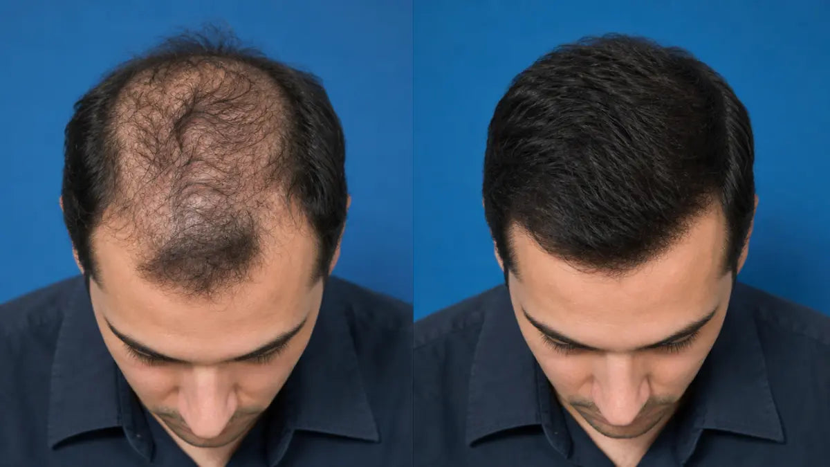 Customer before and after — full crown